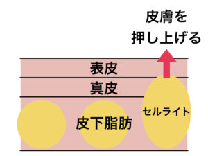 セルライトのイメージ