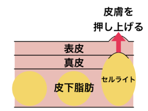 セルライトのイメージ