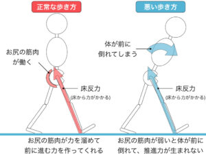 大臀筋の筋力低下による歩行