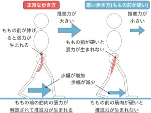 腸腰筋の緊張亢進による歩行への影響